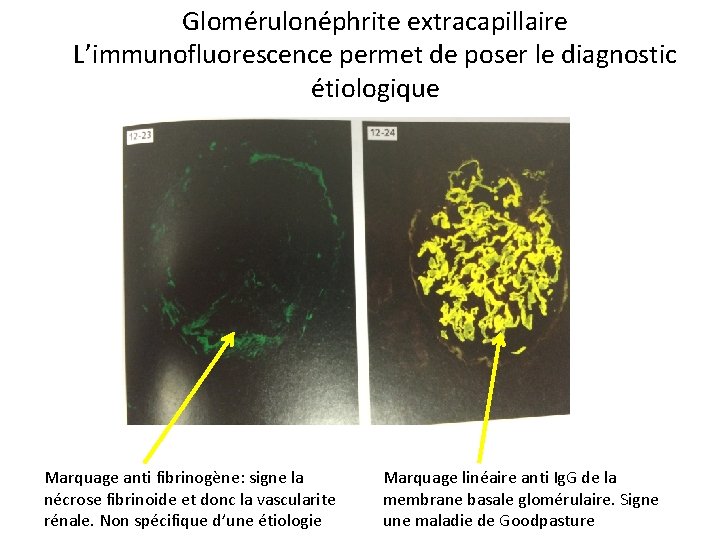 Glomérulonéphrite extracapillaire L’immunofluorescence permet de poser le diagnostic étiologique Marquage anti fibrinogène: signe la