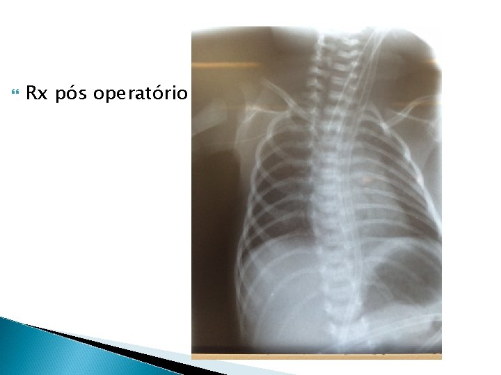  Rx pós operatório 