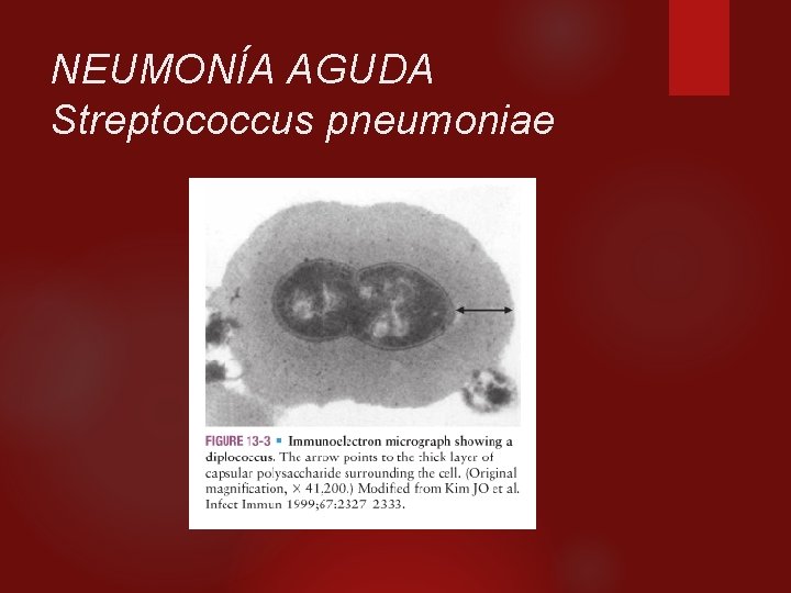 NEUMONÍA AGUDA Streptococcus pneumoniae 