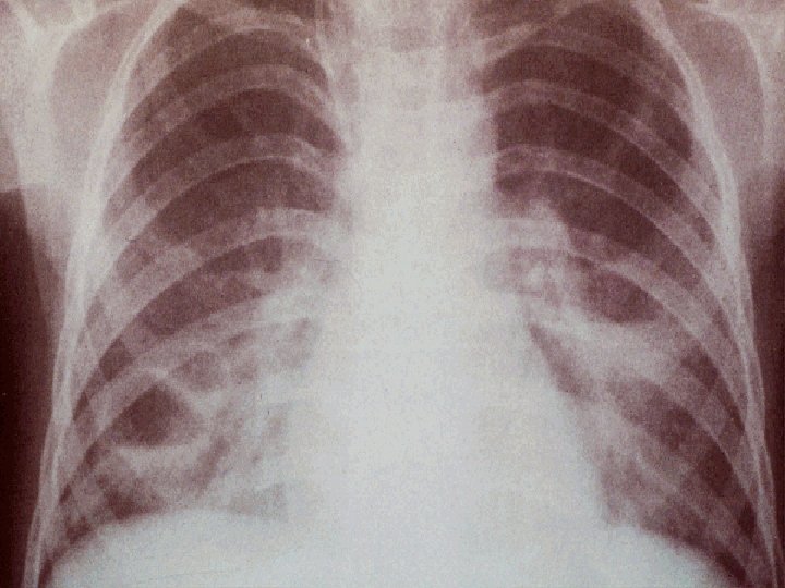 PNEUMONÍA STAPHILOCOCCUS AUREUS 