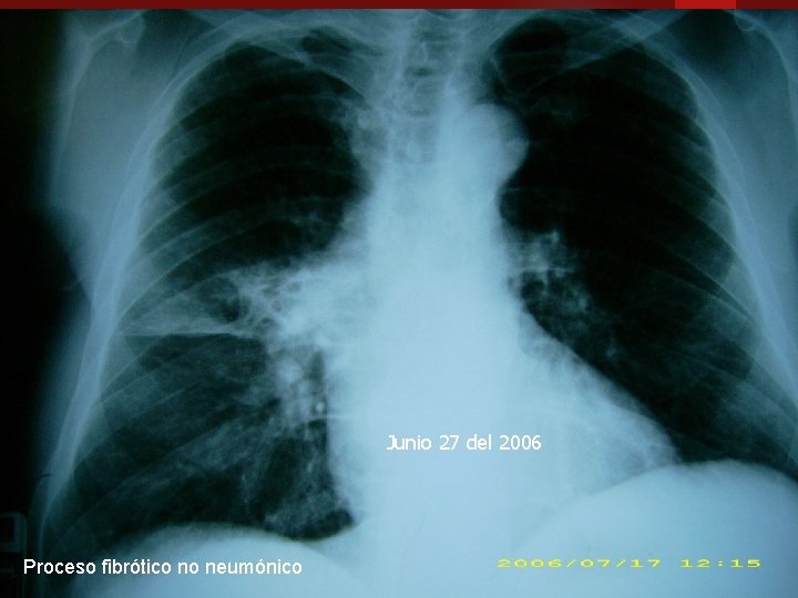 Junio 27 del 2006 Proceso fibrótico no neumónico 