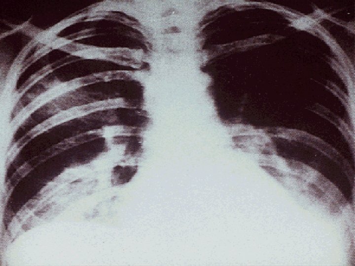 PNEUMONIA MYCOPLASMA PNEUMONIA 