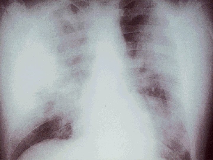 PNEUMONIA LEGIONELLA PNEUMOPHILLA 