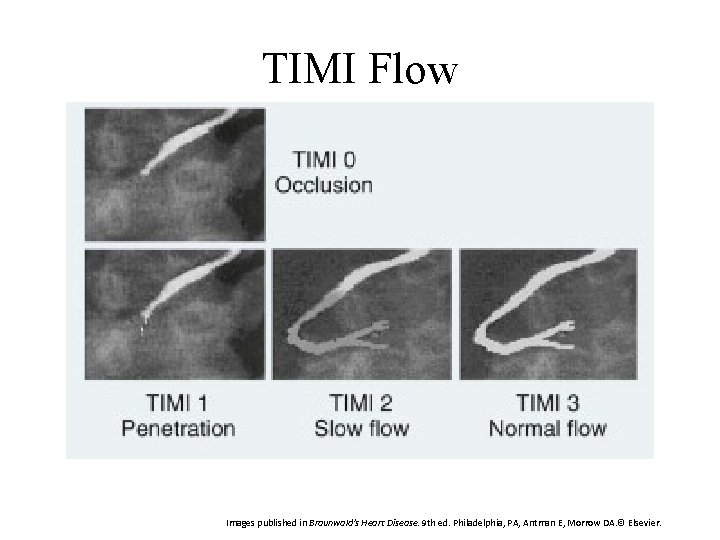 TIMI Flow Images published in Braunwald's Heart Disease. 9 th ed. Philadelphia, PA, Antman