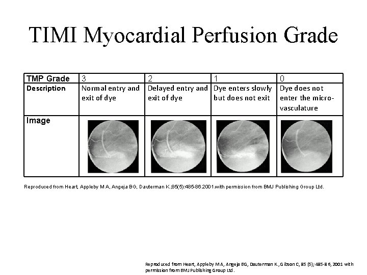 TIMI Myocardial Perfusion Grade TMP Grade Description 3 2 1 0 Normal entry and
