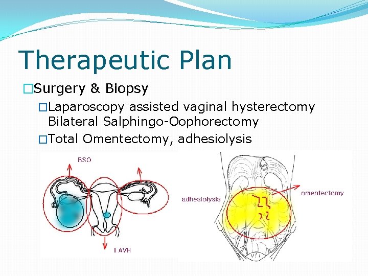 Therapeutic Plan �Surgery & Biopsy �Laparoscopy assisted vaginal hysterectomy Bilateral Salphingo-Oophorectomy �Total Omentectomy, adhesiolysis