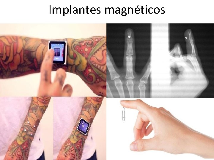 Implantes magnéticos 