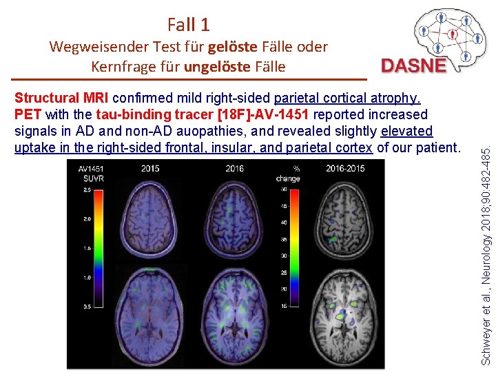 Fall 1 Structural MRI confirmed mild right-sided parietal cortical atrophy. PET with the tau-binding