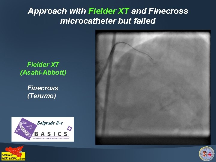 Approach with Fielder XT and Finecross microcatheter but failed Fielder XT (Asahi-Abbott) Finecross (Terumo)