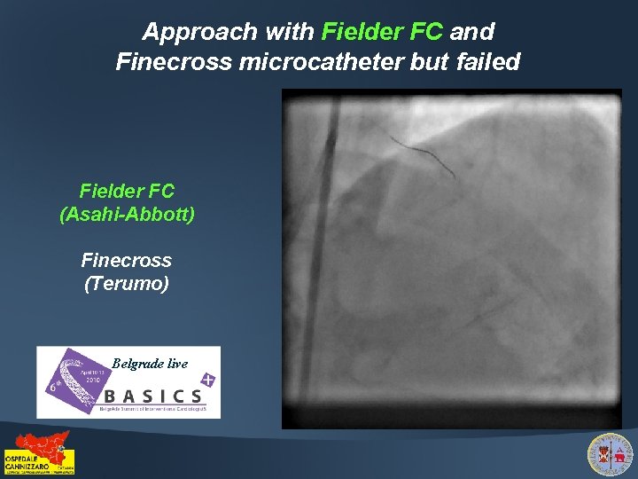Approach with Fielder FC and Finecross microcatheter but failed Fielder FC (Asahi-Abbott) Finecross (Terumo)