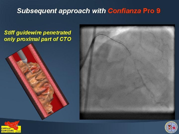 Subsequent approach with Confianza Pro 9 Stiff guidewire penetrated only proximal part of CTO