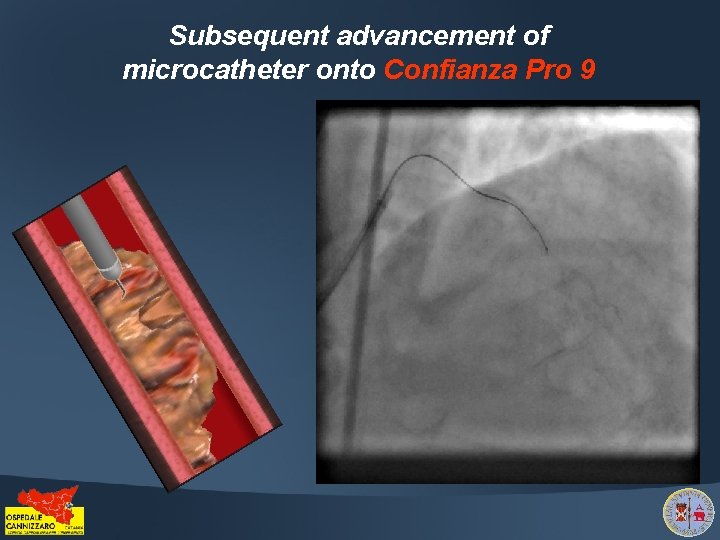 Subsequent advancement of microcatheter onto Confianza Pro 9 