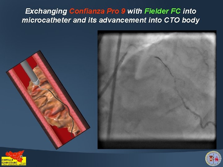 Exchanging Confianza Pro 9 with Fielder FC into microcatheter and its advancement into CTO