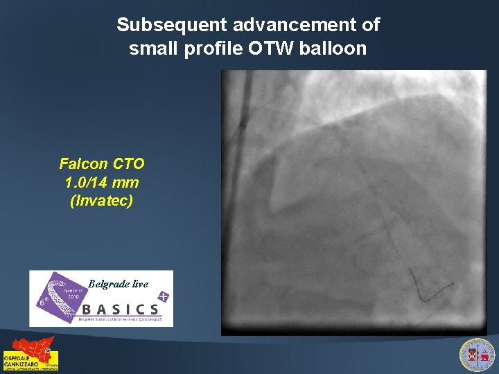 Subsequent advancement of small profile OTW balloon Falcon CTO 1. 0/14 mm (Invatec) Belgrade