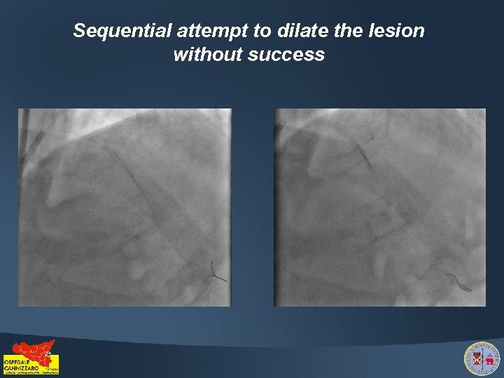 Sequential attempt to dilate the lesion without success 