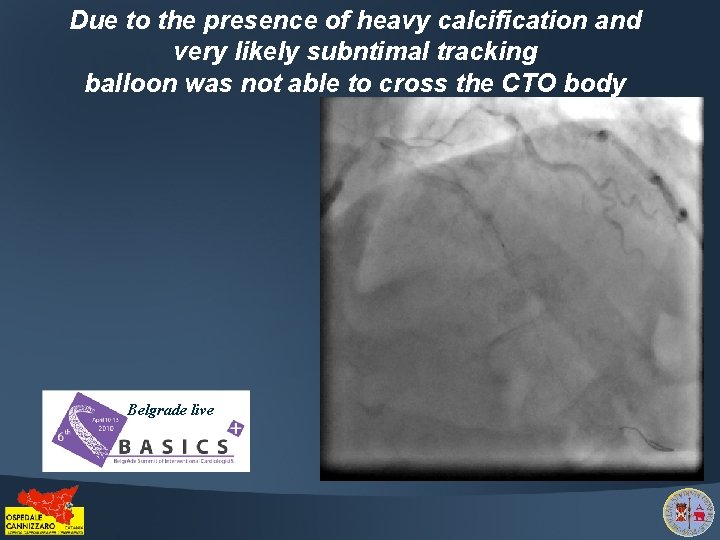 Due to the presence of heavy calcification and very likely subntimal tracking balloon was