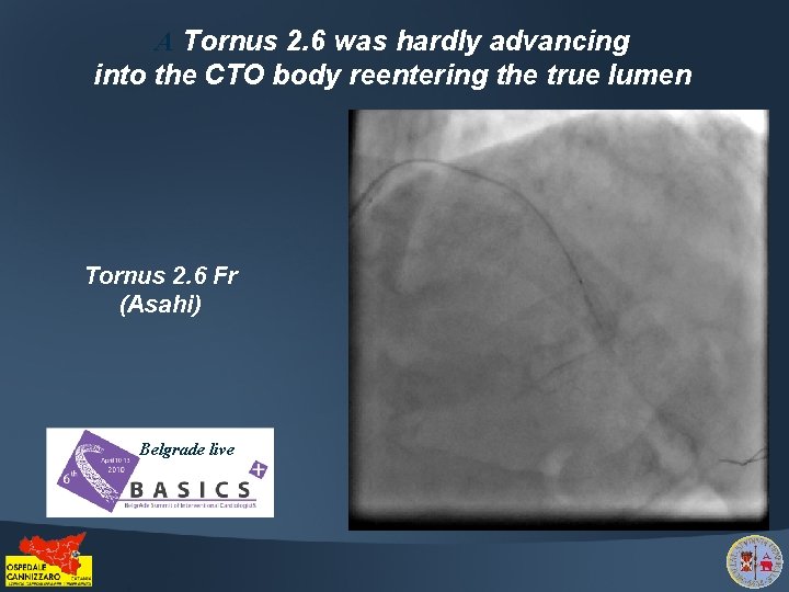 A Tornus 2. 6 was hardly advancing into the CTO body reentering the true