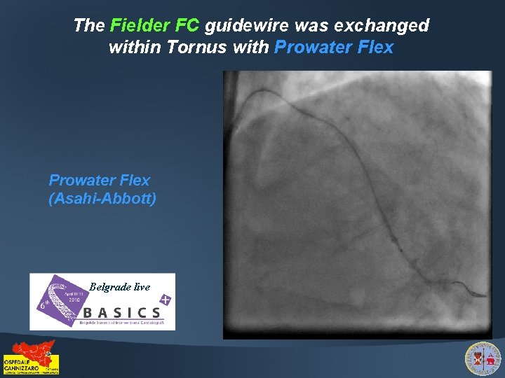 The Fielder FC guidewire was exchanged within Tornus with Prowater Flex (Asahi-Abbott) Belgrade live