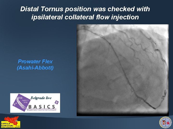 Distal Tornus position was checked with ipsilateral collateral flow injection Prowater Flex (Asahi-Abbott) Belgrade