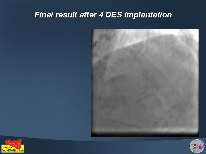 Final result after 4 DES implantation 