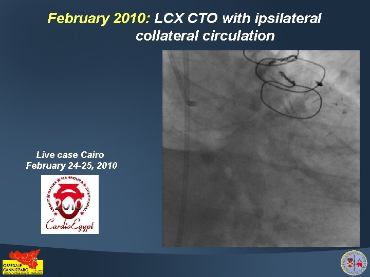 February 2010: LCX CTO with ipsilateral collateral circulation Live case Cairo February 24 -25,