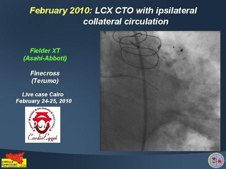 February 2010: LCX CTO with ipsilateral collateral circulation Fielder XT (Asahi-Abbott) Finecross (Terumo) Live