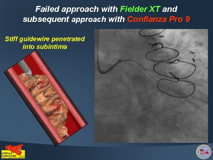 Failed approach with Fielder XT and subsequent approach with Confianza Pro 9 Stiff guidewire