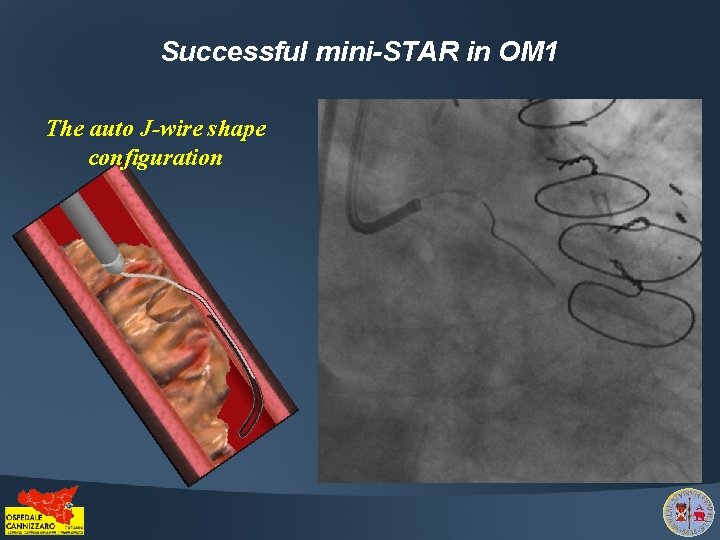 Successful mini-STAR in OM 1 The auto J-wire shape configuration 