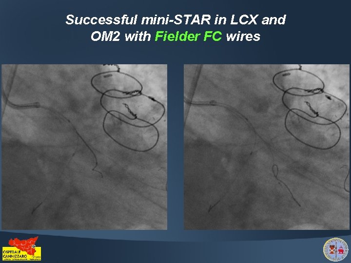 Successful mini-STAR in LCX and OM 2 with Fielder FC wires 