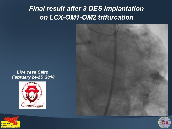 Final result after 3 DES implantation on LCX-OM 1 -OM 2 trifurcation Live case