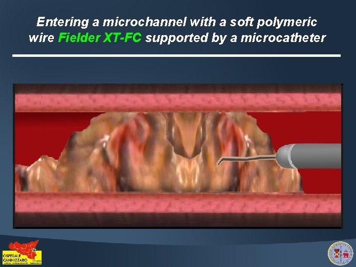 Entering a microchannel with a soft polymeric wire Fielder XT-FC supported by a microcatheter
