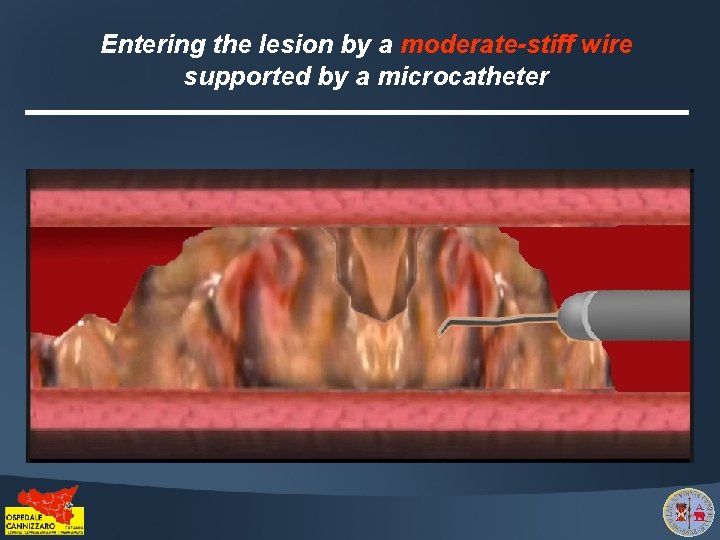 Entering the lesion by a moderate-stiff wire supported by a microcatheter 