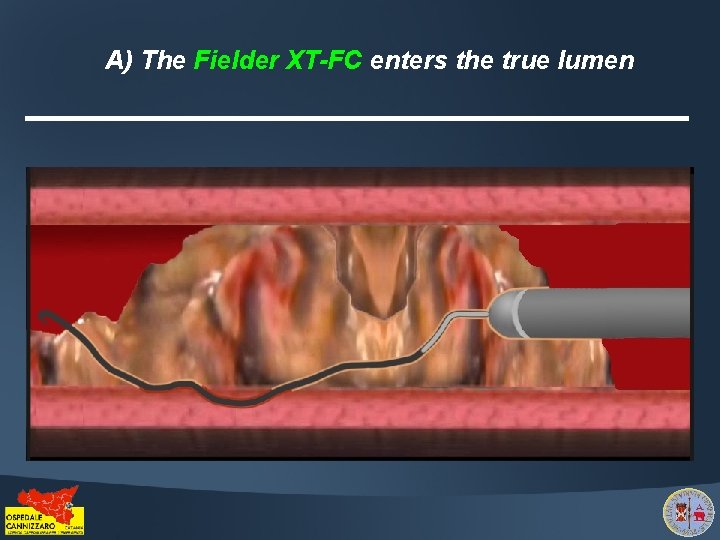 A) The Fielder XT-FC enters the true lumen 