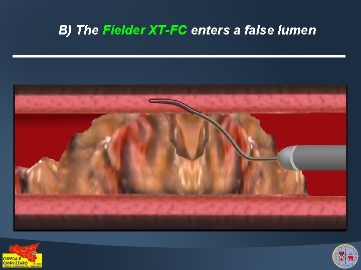 B) The Fielder XT-FC enters a false lumen 