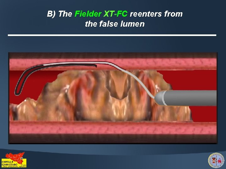 B) The Fielder XT-FC reenters from the false lumen 