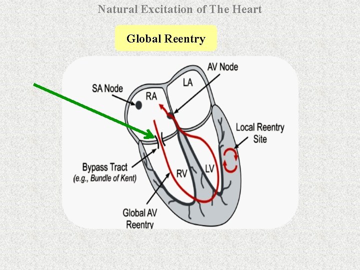 Natural Excitation of The Heart Global Reentry 