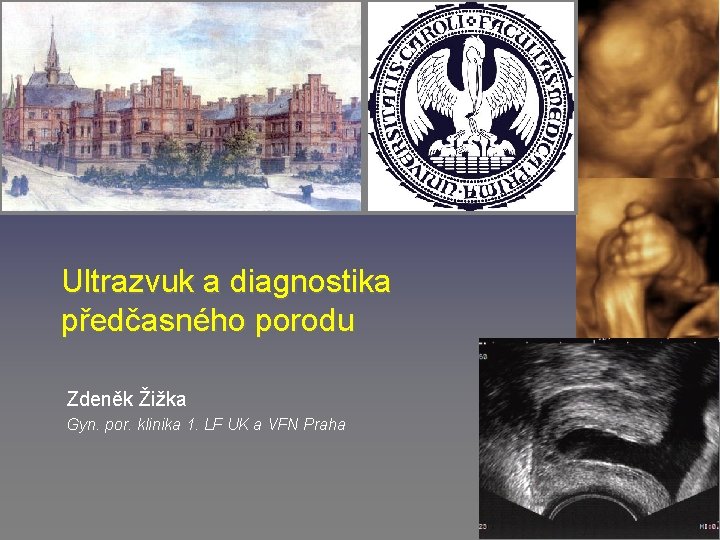 Ultrazvuk a diagnostika předčasného porodu Zdeněk Žižka Gyn. por. klinika 1. LF UK a