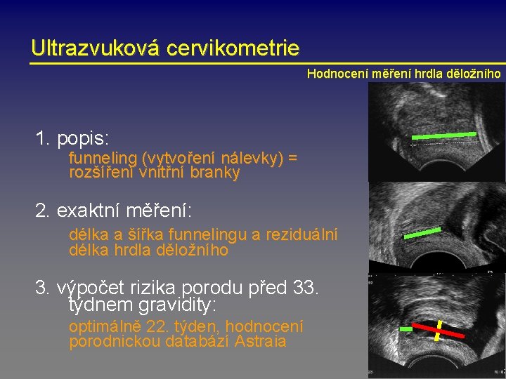 Ultrazvuková cervikometrie Hodnocení měření hrdla děložního 1. popis: funneling (vytvoření nálevky) = rozšíření vnitřní