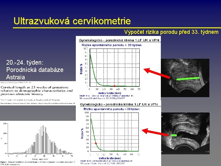 Ultrazvuková cervikometrie Výpočet rizika porodu před 33. týdnem 20. -24. týden: Porodnická databáze Astraia