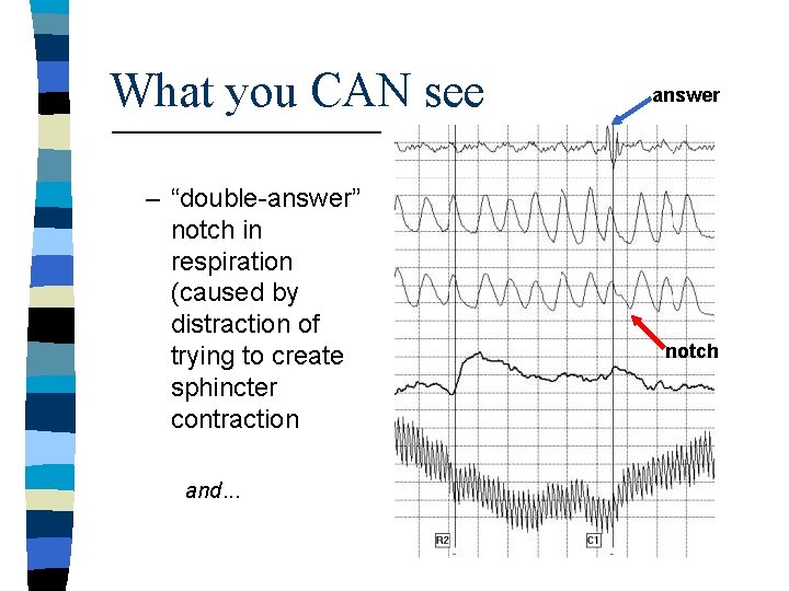 What you CAN see – “double-answer” notch in respiration (caused by distraction of trying