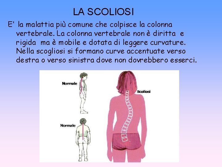 LA SCOLIOSI E' la malattia più comune che colpisce la colonna vertebrale. La colonna
