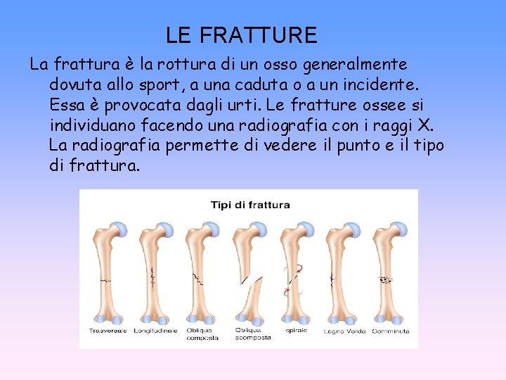 LE FRATTURE La frattura è la rottura di un osso generalmente dovuta allo sport,