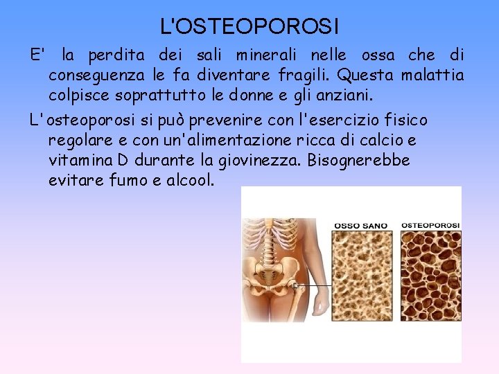 L'OSTEOPOROSI E' la perdita dei sali minerali nelle ossa che di conseguenza le fa