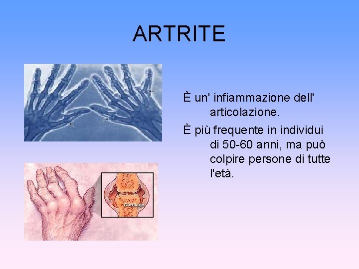 ARTRITE È un' infiammazione dell' articolazione. È più frequente in individui di 50 -60