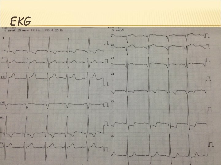 EKG 