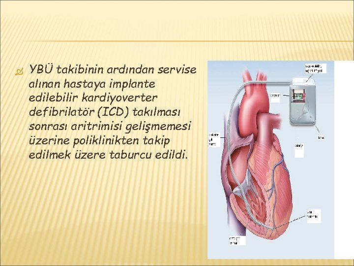  YBÜ takibinin ardından servise alınan hastaya implante edilebilir kardiyoverter defibrilatör (ICD) takılması sonrası