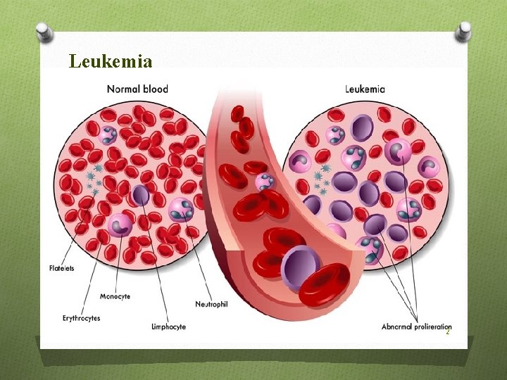Leukemia 2 