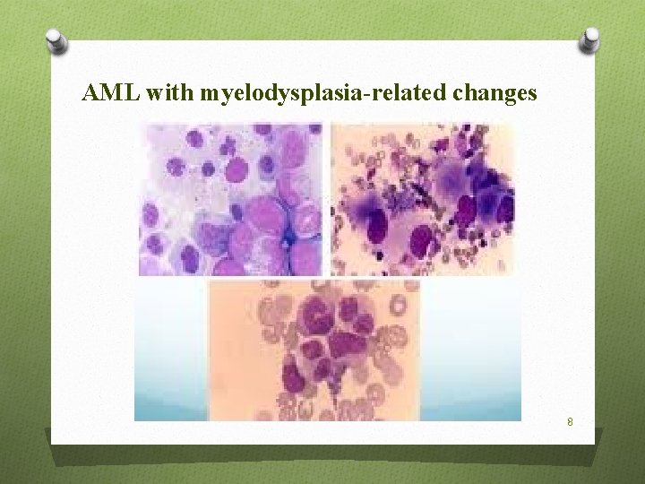 AML with myelodysplasia-related changes 8 