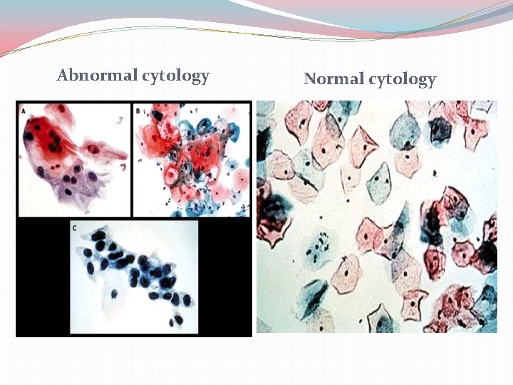 Abnormal cytology Normal cytology 