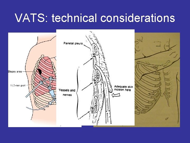 VATS: technical considerations 